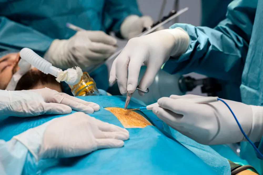 Laparoscopic Surgery for Ovarian Cyst