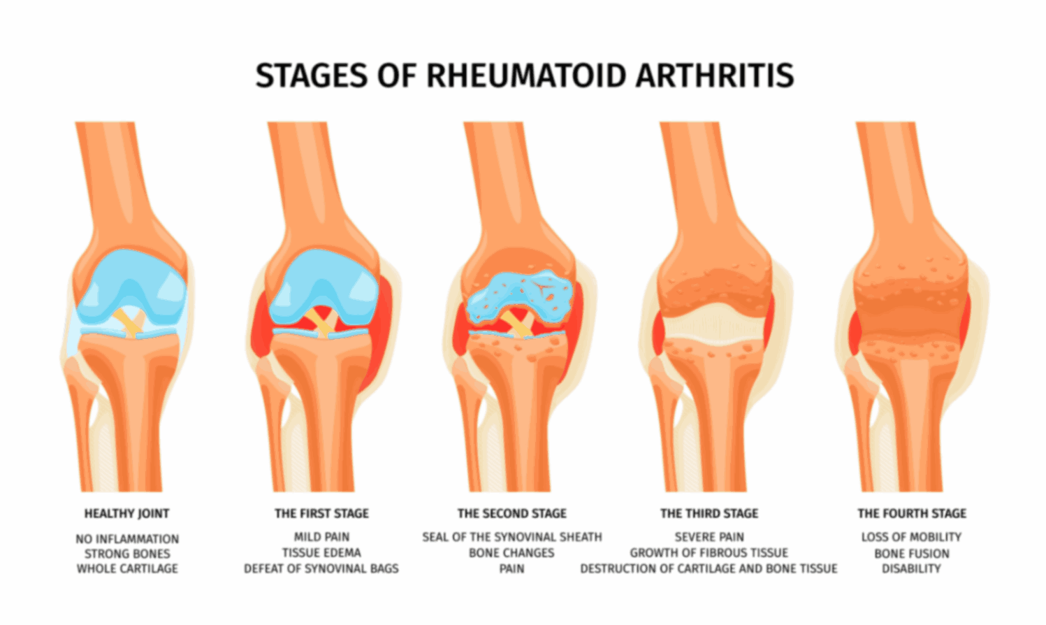 Stages of Rheumatoid Arthritis: Symptoms & Progression