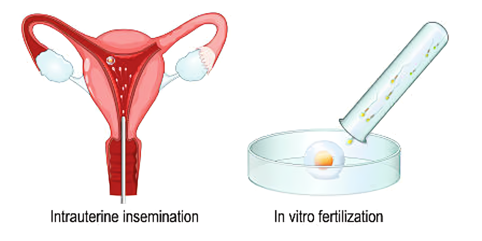 IUI vs IVF: Which Fertility Treatment is Right for You?