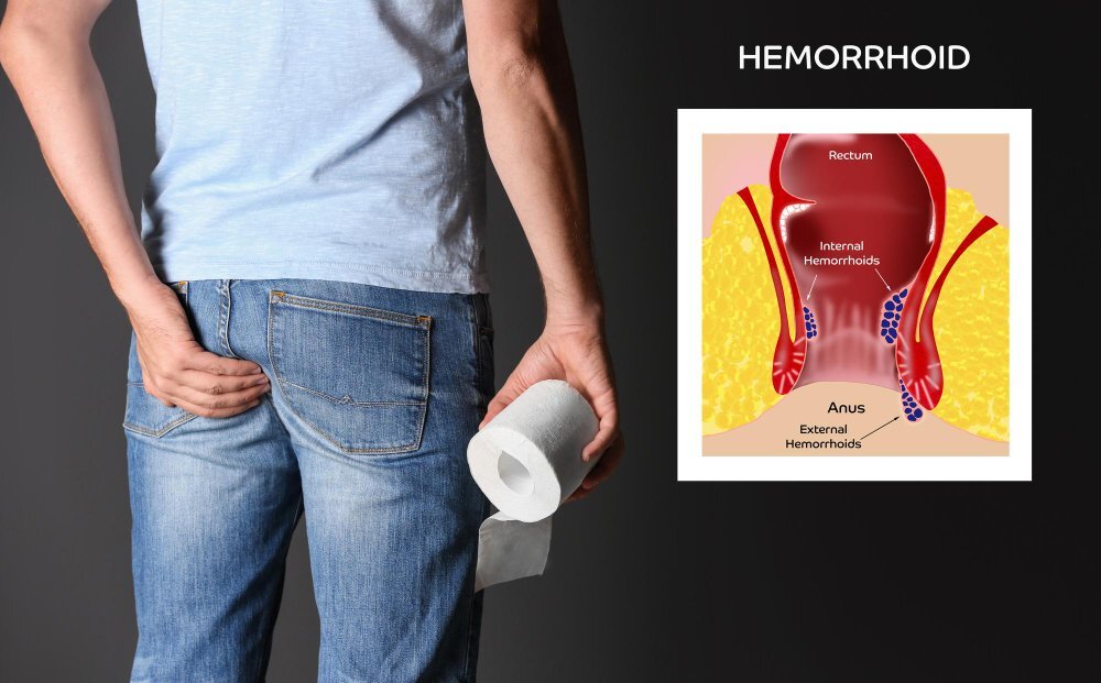 Piles Treatment In Nepal: Types, Symptoms and Best Solution At Venus Hospital