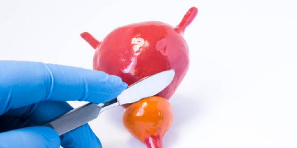 Everything You Need to Know About Prostate TURP Surgery