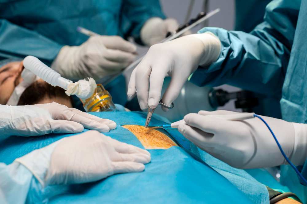 Laparoscopic Cholecystectomy Concept.