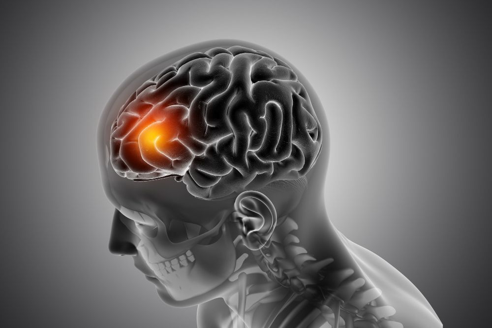 Symptoms Of TBI