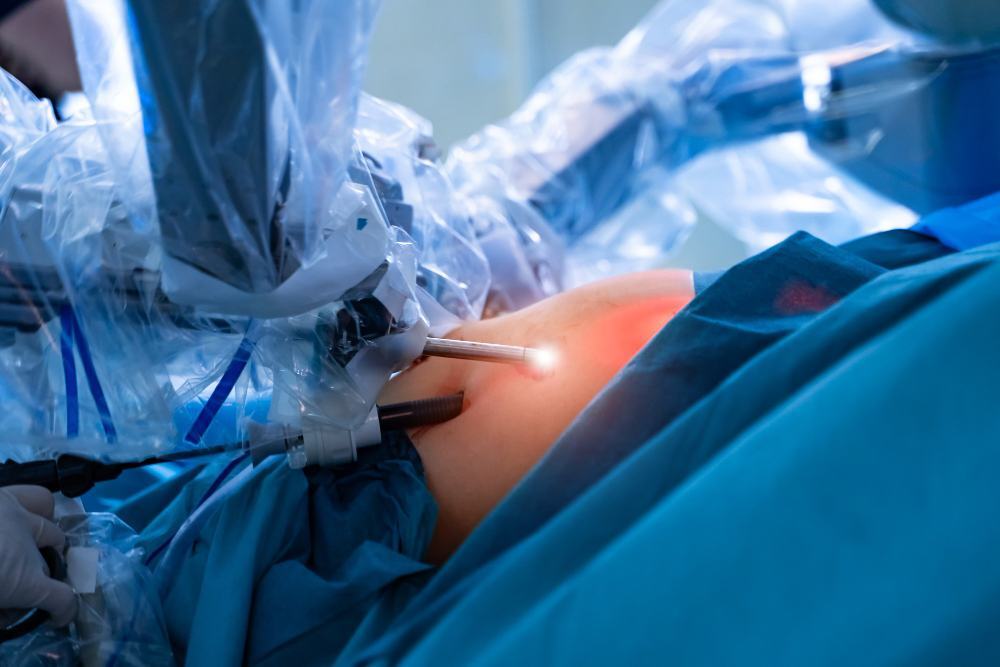 Benefits Of Laparoscopic Appendectomy