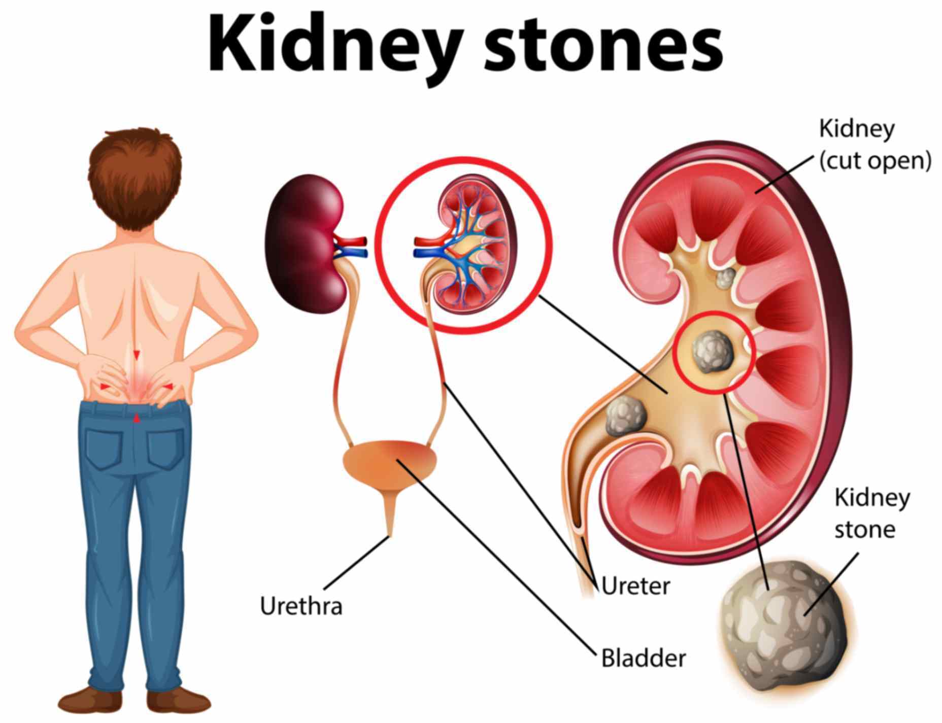 kidney-stone.jpeg Kidney Stone